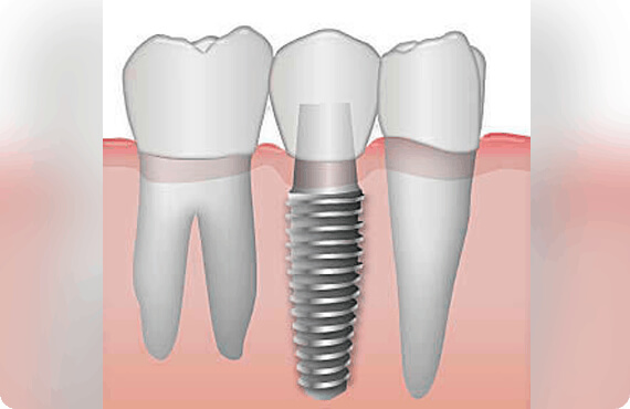 All on 4 dental implants in Ahmedabad