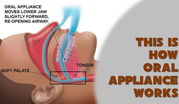 Snoring Treatment in Ahmedabad