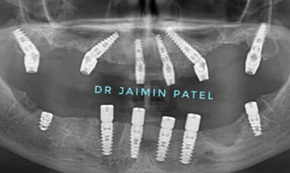 Zygomatic Implants