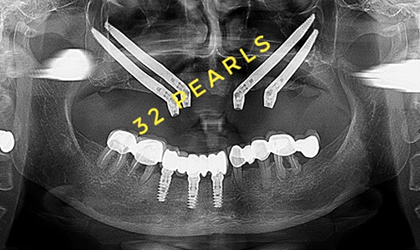 Zygomatic Implants