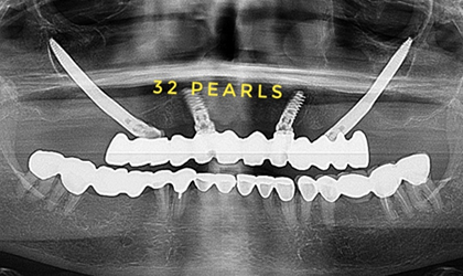 Zygomatic Implants