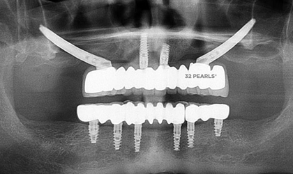 Zygomatic Implants