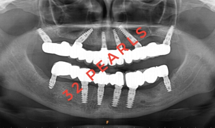 Zygomatic Implants